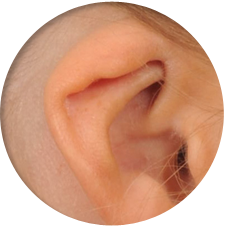 その他の耳介奇形（折れ耳、埋没耳、スタール耳など)